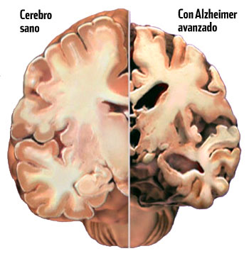 Prevenció de l'Alzheimer