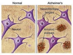 Millora la detecció precoç del Alzheimer.