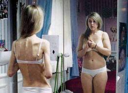 Diferències cerebrals entre persones anorèxiques i obeses