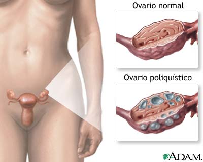 El 70% dels càncers d'ovari es fa resistent al tractament de primera línia