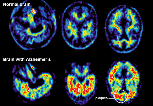 Els experts desenvolupen una programa contra l'Alzheimer